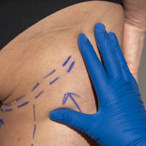 Butt lift treatment Delhi