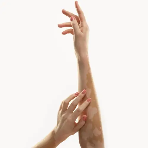 Vitiligo Treatment