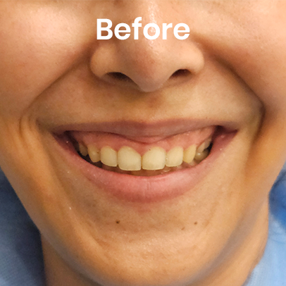 Gummy smile treated with botox before