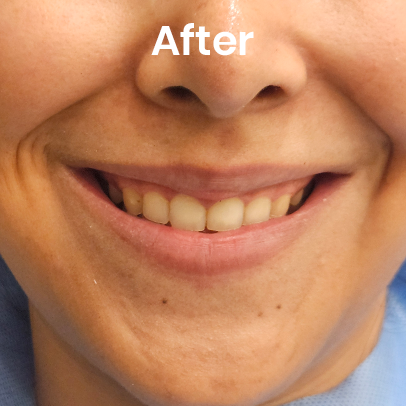 Gummy smile treated with botox after