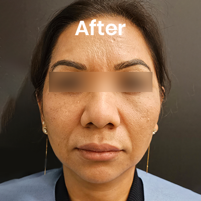 Microblading after