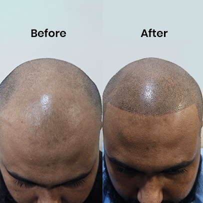 Scalp micropigmentation transformation Delhi